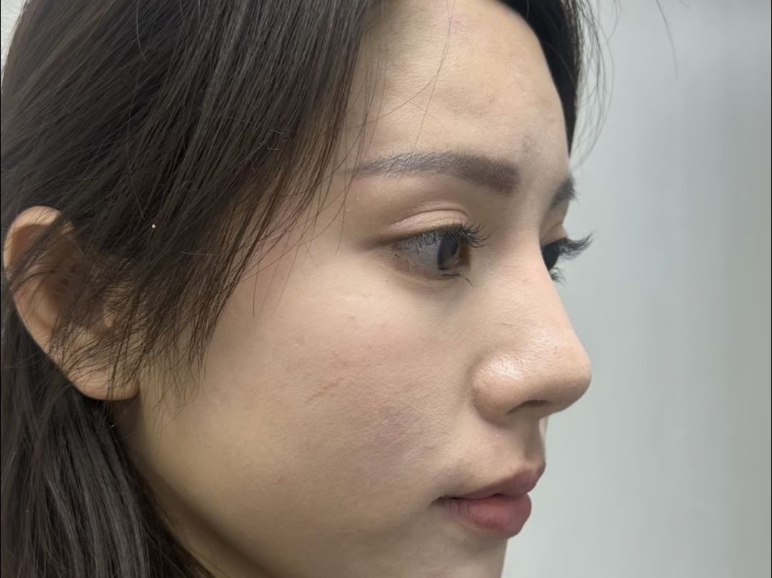 鼻翼缘退缩植皮,术后三个月反馈