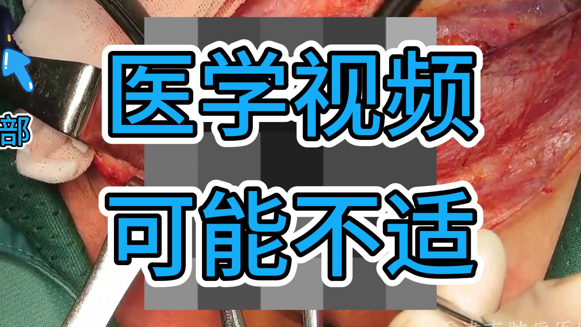右侧甲状腺右叶+峡部切除+淋巴结清扫(第一部分)