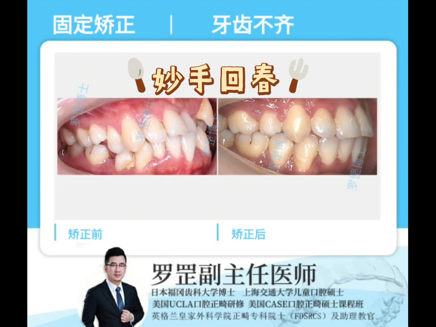 【罗罡矫正案例分享】重度牙齿拥挤、不齐、深覆合,也有对应解决方法~哔哩哔哩bilibili