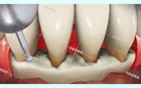 牙槽骨吸收严重翻瓣术了解一下吧哔哩哔哩bilibili