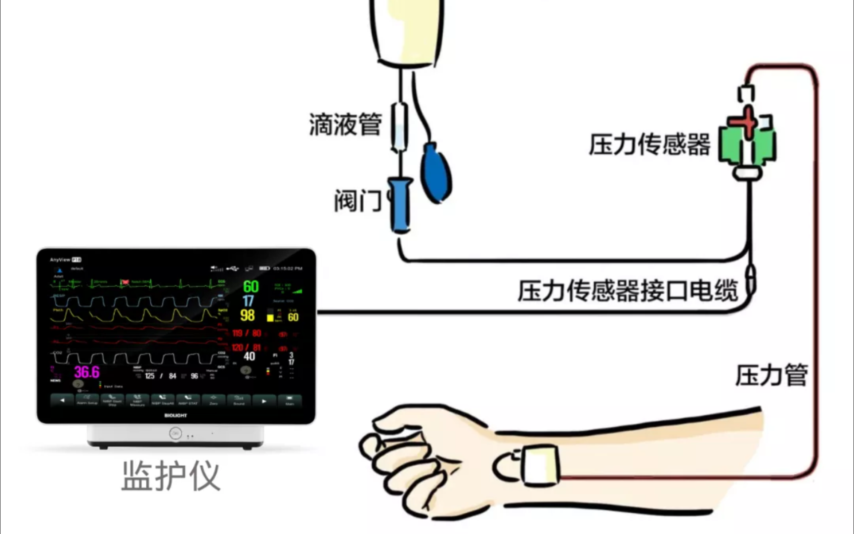 动脉穿刺置管+有创血压监测护士老师的操作,将近300斤的大胖子合并低血压,血管条件很差,没用超声护士老师一针扎上.哔哩哔哩bilibili