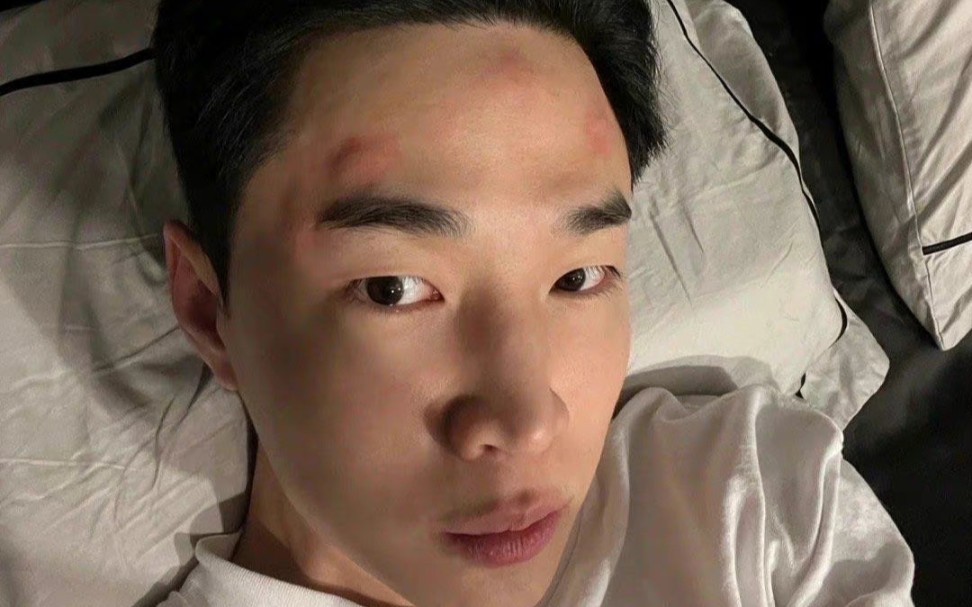 刘宪华被蚊子咬得满头包!又可怜又好笑!