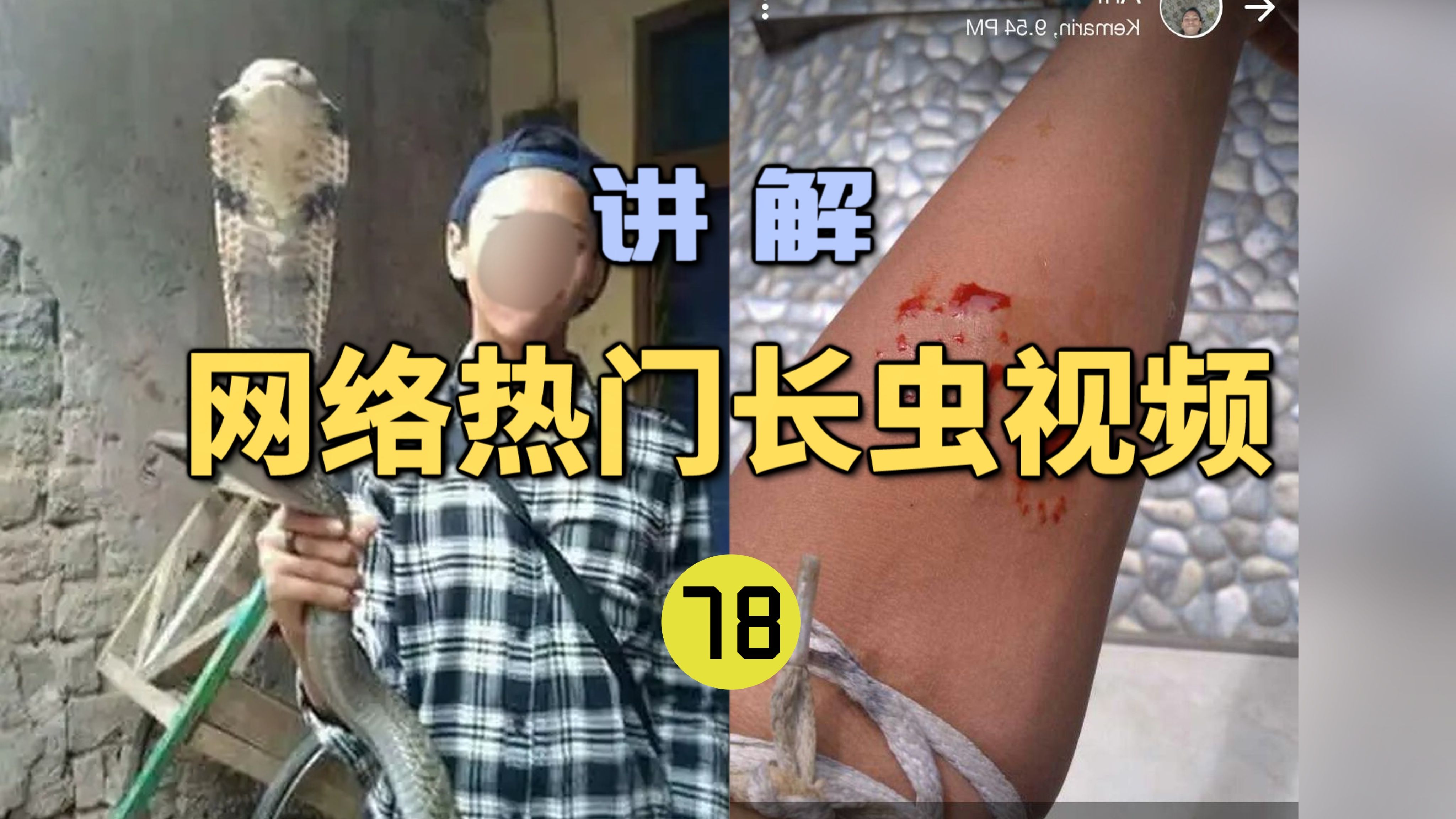 [图]网络热门长虫视频(78)年仅14岁男孩饲养眼镜王蛇被咬伤！不去医院在朋友圈求助？