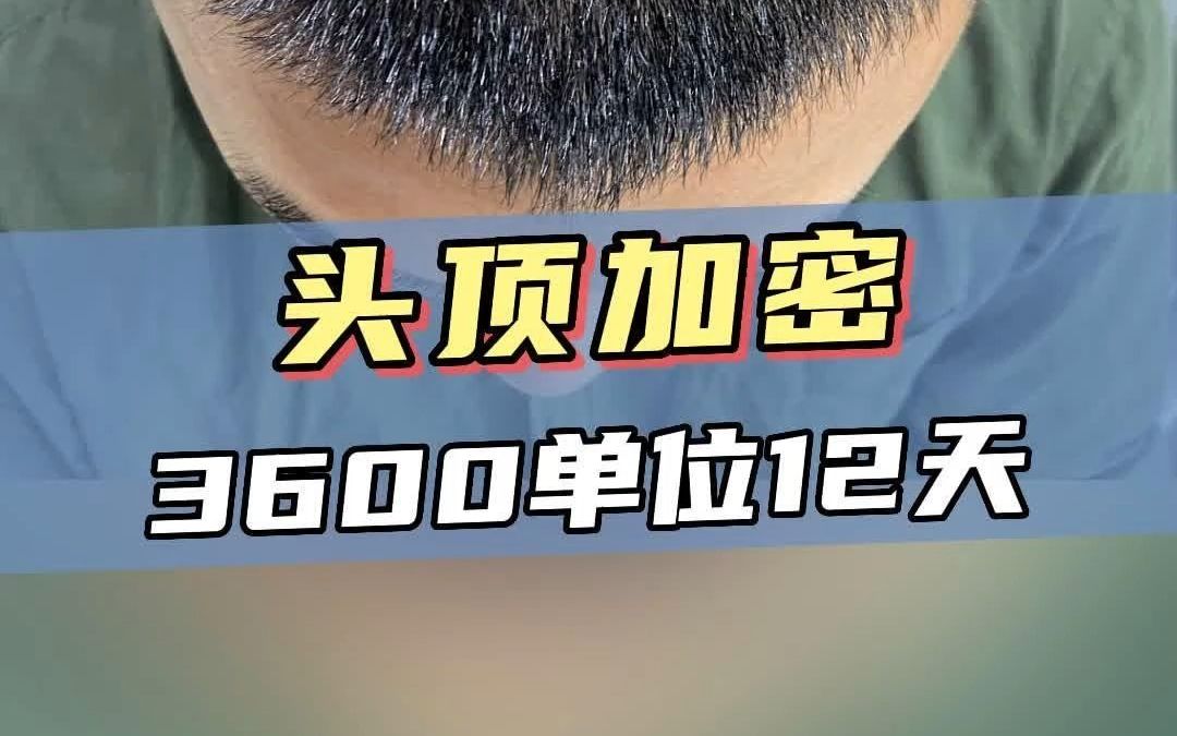 男生头顶稀疏,头顶加密3600毛囊单位12天分享