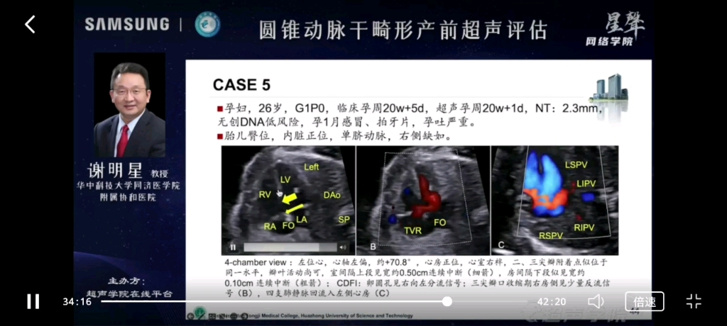 谢明星讲动脉圆锥干畸形产前超声评估哔哩哔哩bilibili