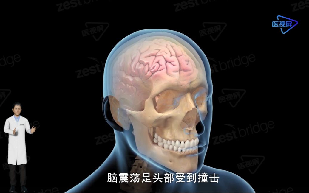 医学3D:脑震荡哔哩哔哩bilibili