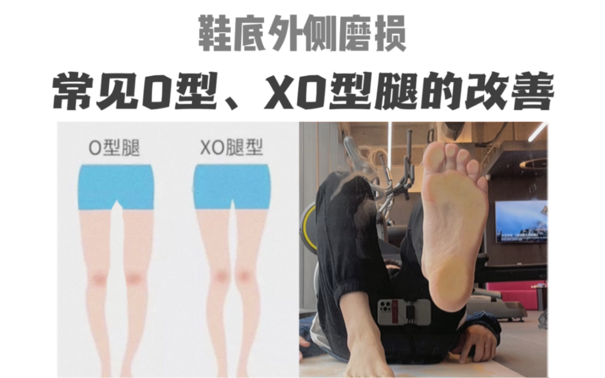 風仔o型xo型腿看過來通過鞋底外側磨損來找出答案