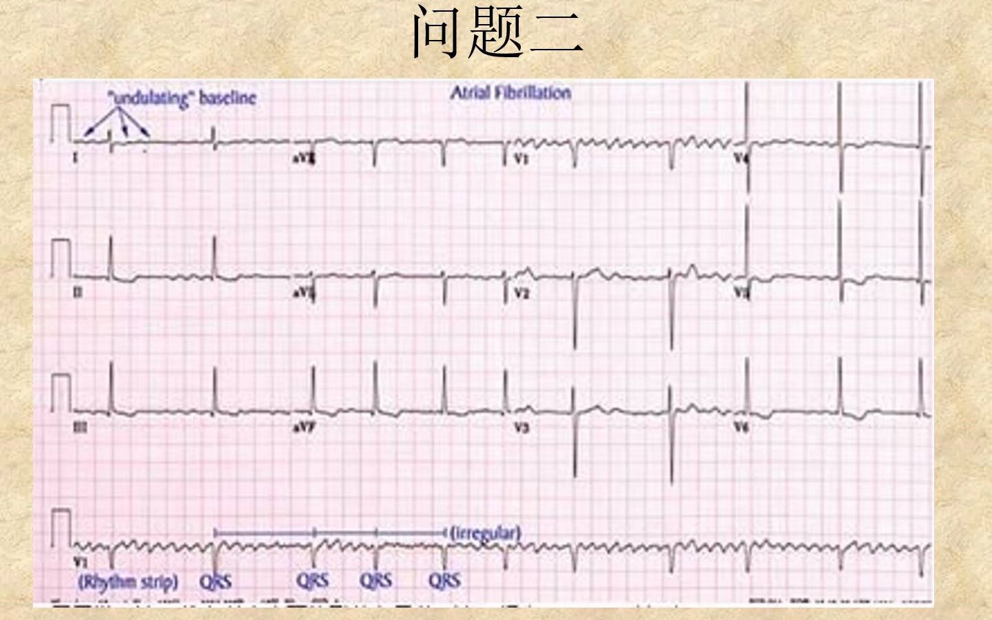 常见心律失常的心电图识别PPT哔哩哔哩bilibili