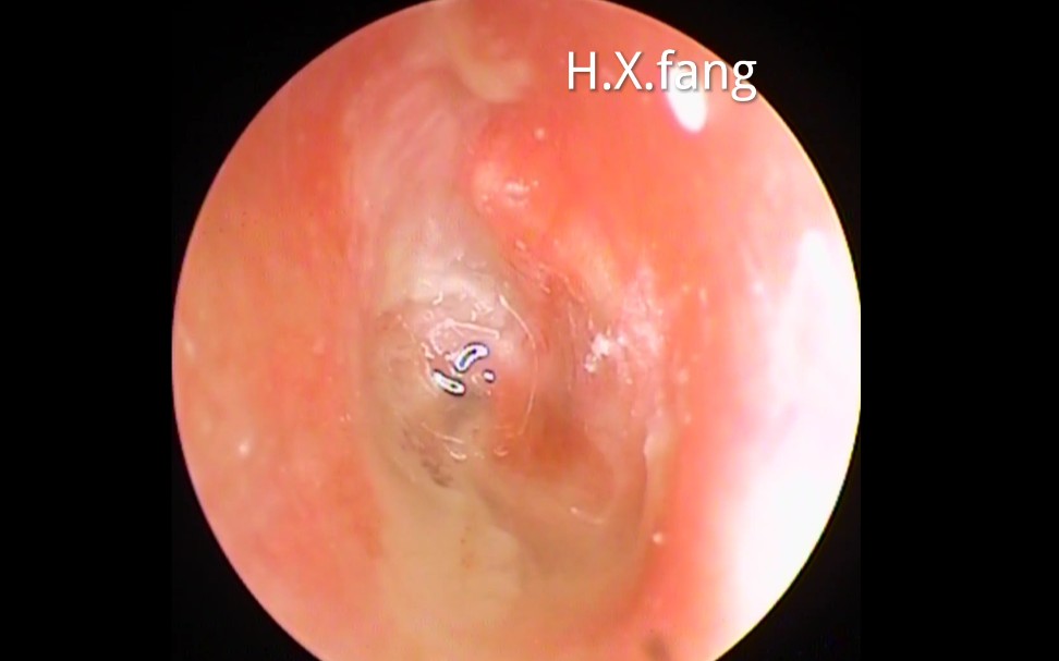 专业可视采耳脓性分泌物清理 鼓膜穿孔20240226.01哔哩哔哩bilibili