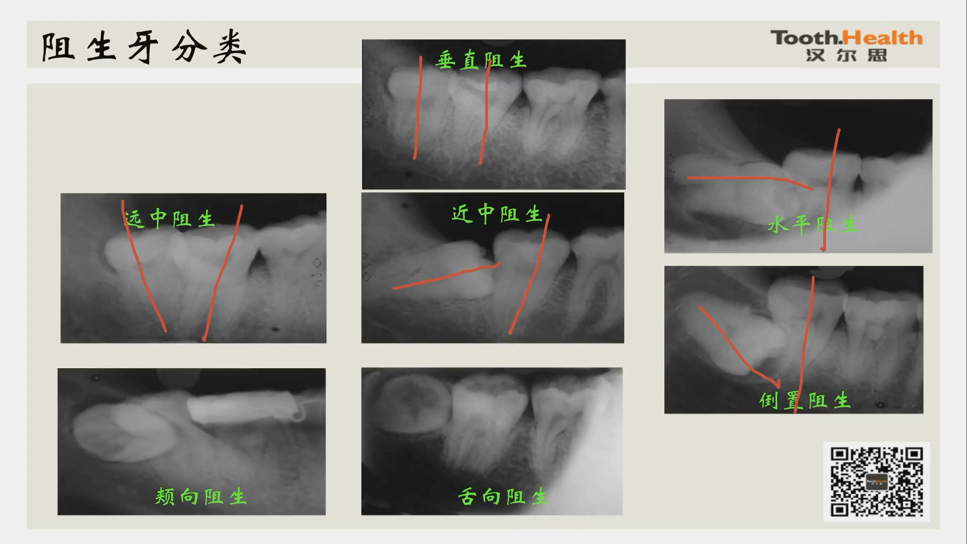 各種阻生牙的阻力分析和分牙策略——漢爾思