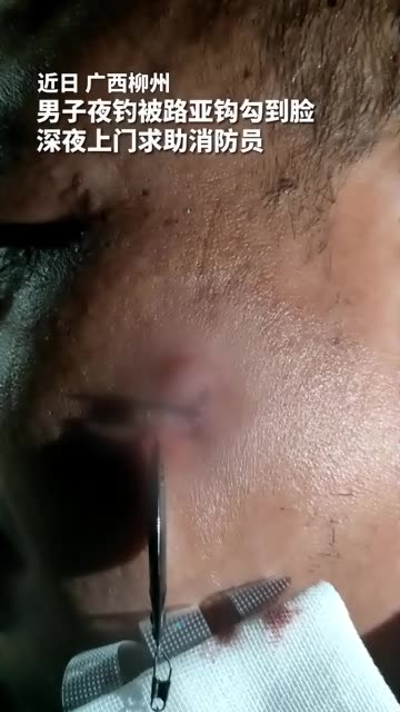 男子夜钓被路亚钩勾到脸,嵌入皮肉深处,深夜上门求助消防员