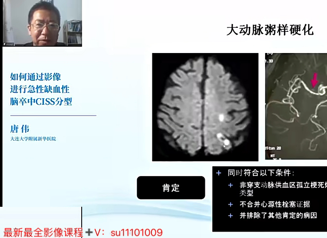 唐伟:脑血管病影像与临床梅斯精品课———大动脉粥样硬化第3讲(共28讲)哔哩哔哩bilibili