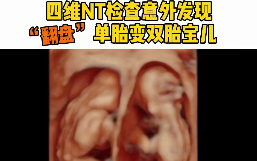 [图]四维NT检查意外发现，翻盘单胎变双胎宝玛莉亚