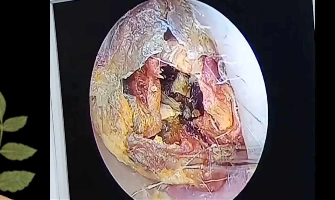 一辈子没掏过耳朵、整个耳道被堵的严严实实、恐怖的胆脂瘤 !!哔哩哔哩bilibili