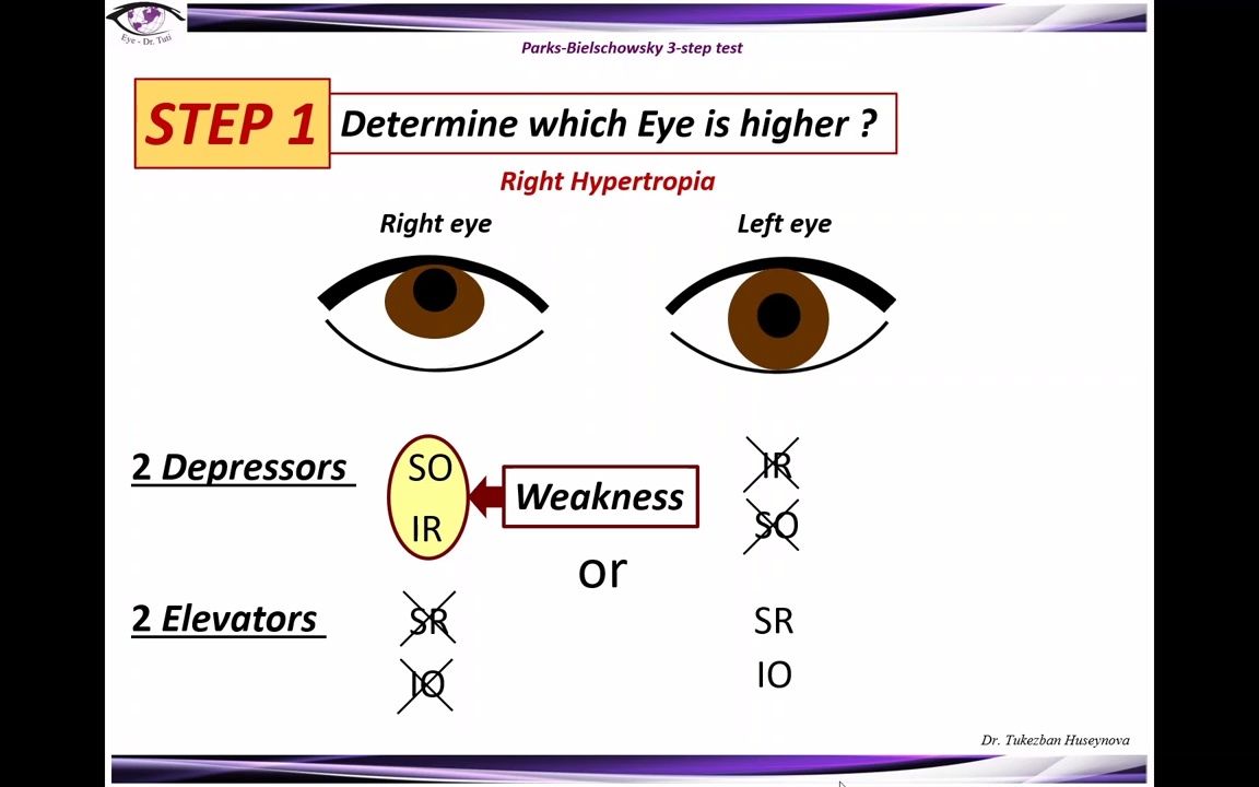 Parks  Bielschowsky 3  Step Test  Parks三步法及歪头试验哔哩哔哩bilibili