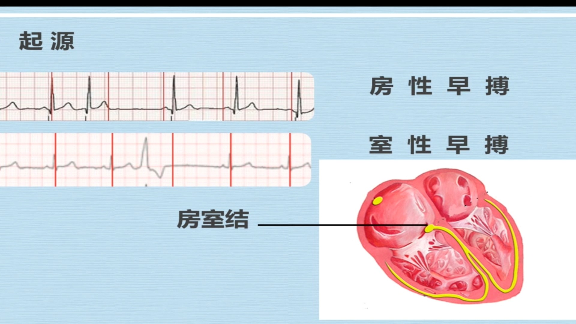 【心电图该怎么看】心电图基础及异常心电图识别与判读哔哩哔哩bilibili