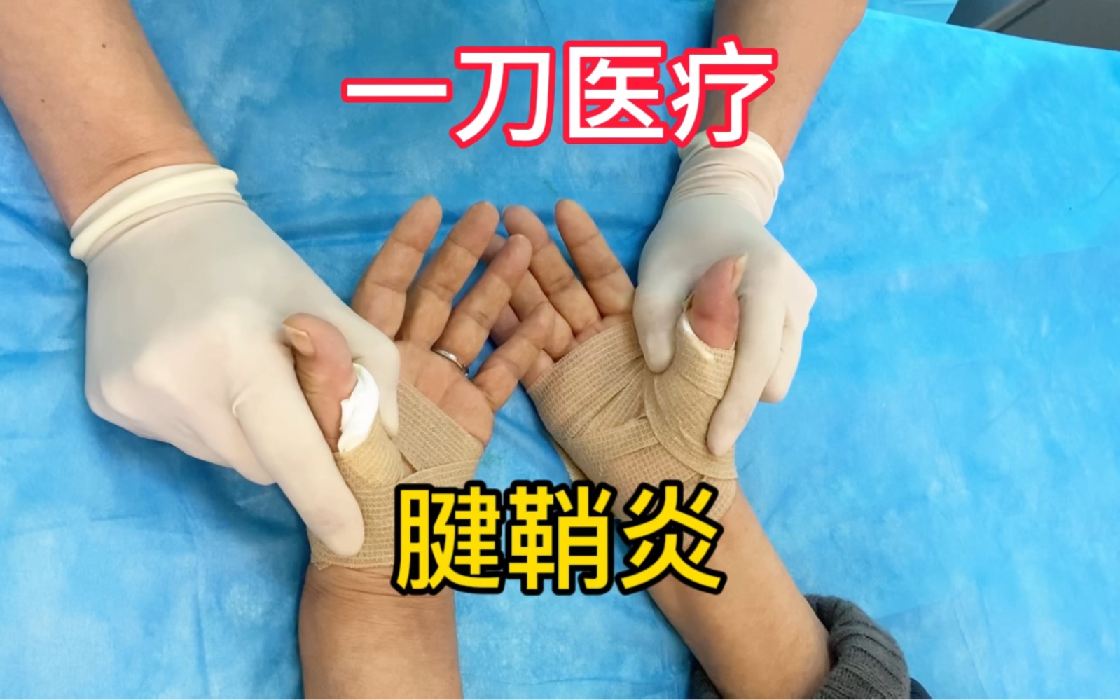 拇指腱鞘炎一次性根治技术:一刀培训