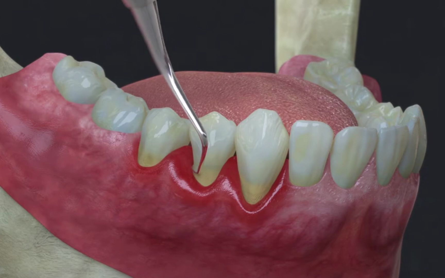 牙周基础治疗过程操作示例
