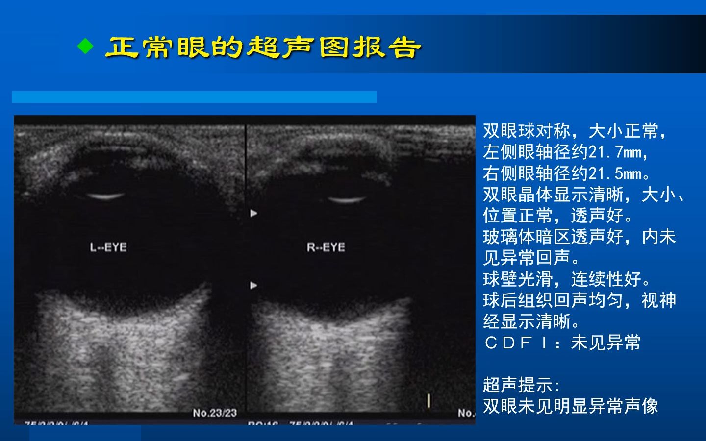 眼部B超的检查方法与常见病的图像及诊断PPT哔哩哔哩bilibili