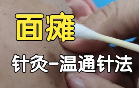 [图]面瘫，口角歪斜， 针灸治疗效果显著