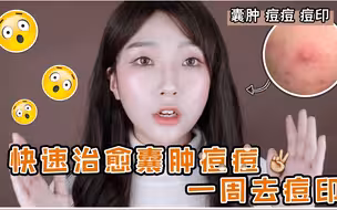 阿图 快速治愈囊肿型痘痘 去痘印不留痕