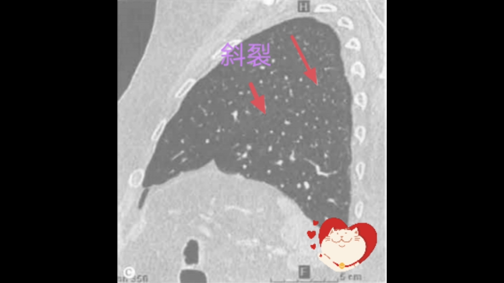 胸片侧位:假胸膜牵拉征象哔哩哔哩bilibili