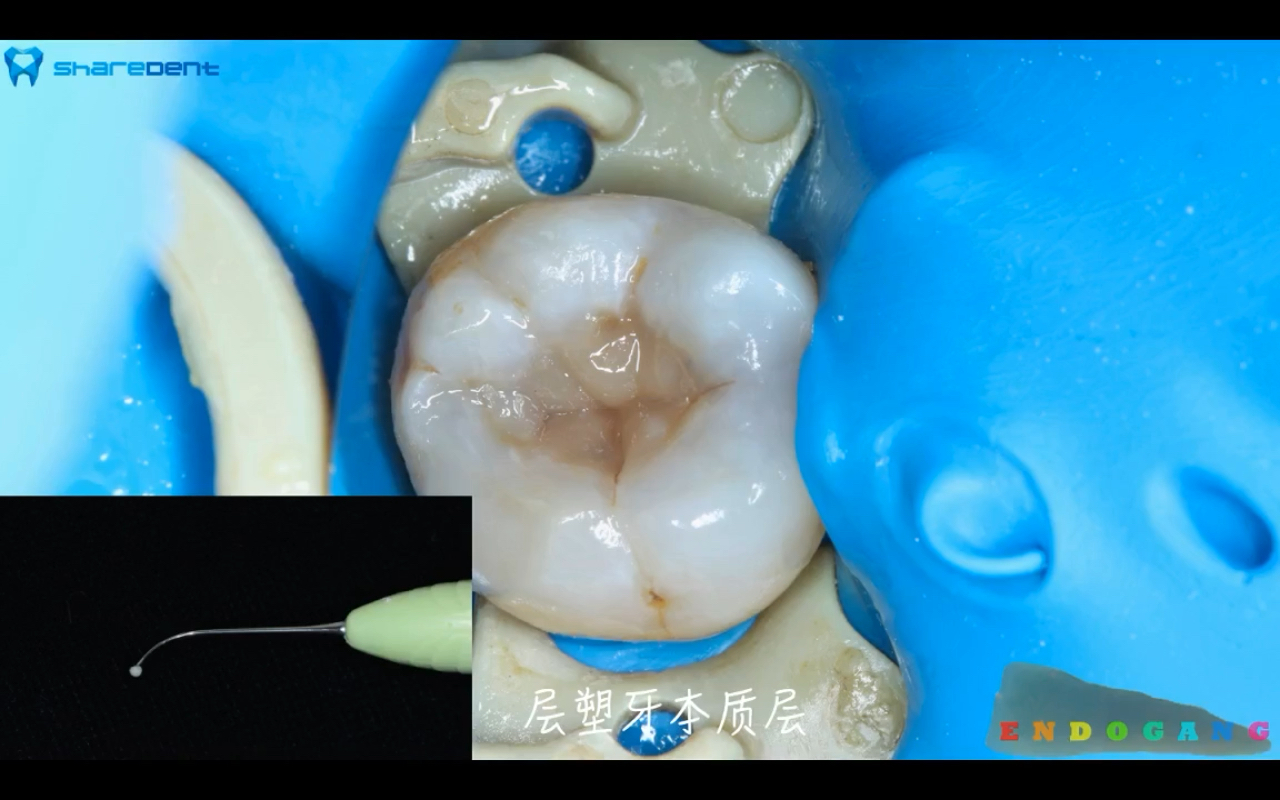 复合树脂微创美学修复系列课第4讲前牙形态——喻刚(共20节)