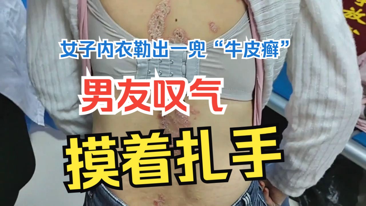 女子内衣勒出一兜“牛皮癣”。男友叹气：摸着扎手！
