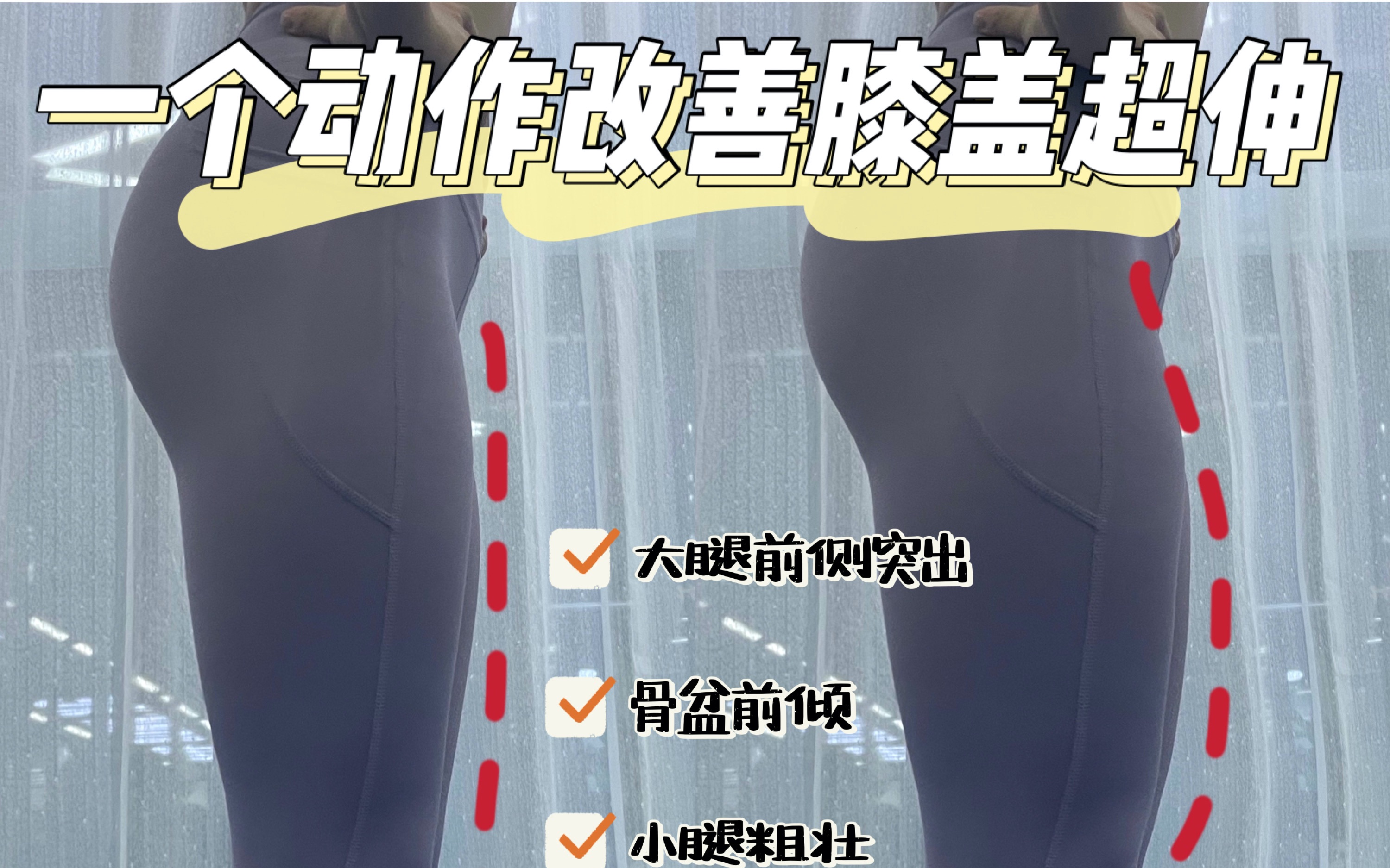 一个动作纠正膝盖超伸改善膝盖疼痛大腿外翻