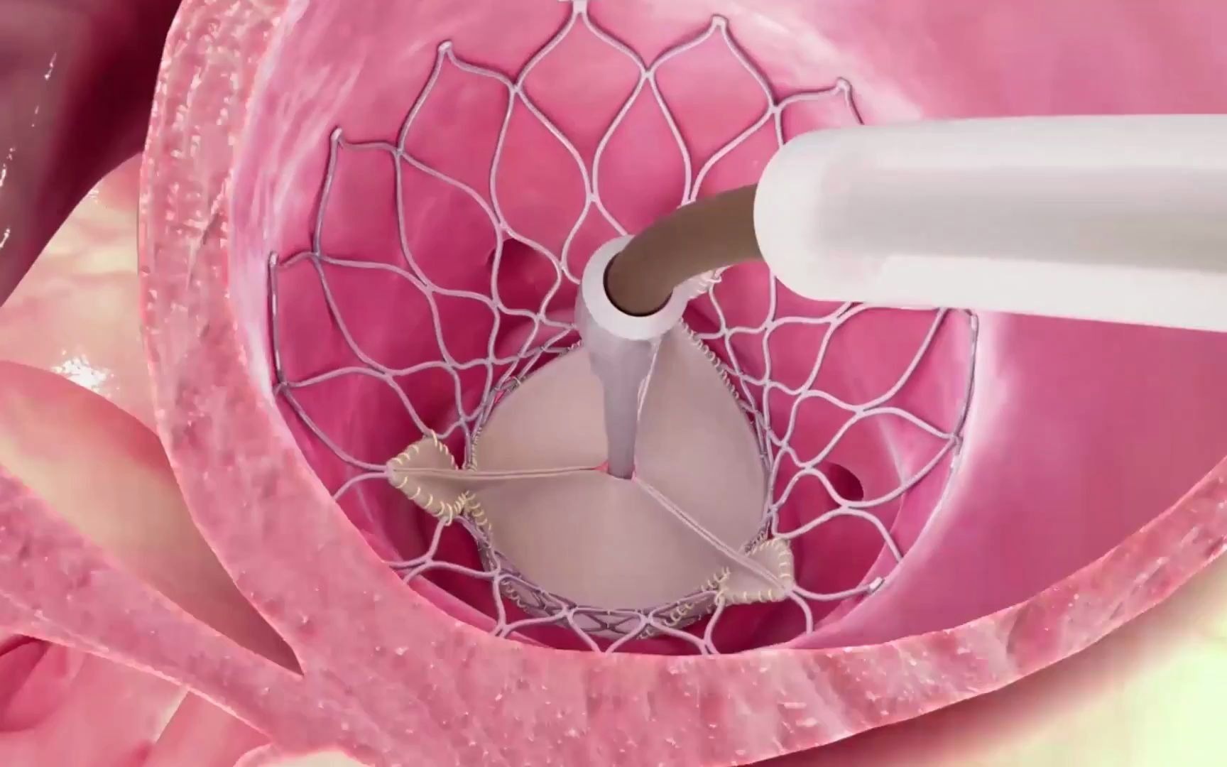 经导管主动脉瓣置换术(tavr)