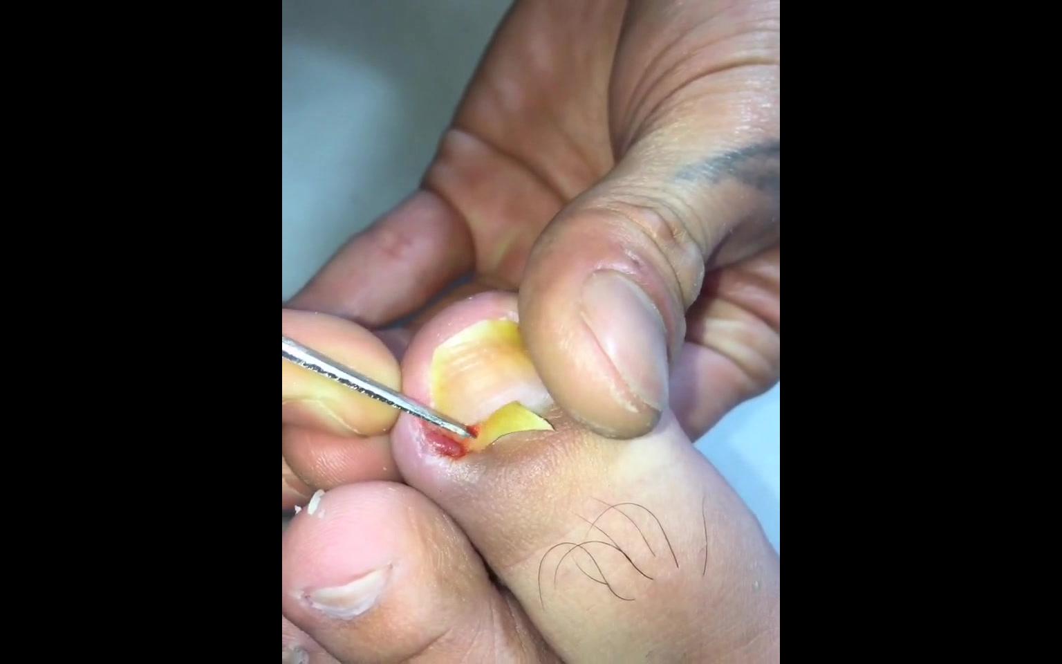 high-tech pull out ingrown toenail,輕微甲溝炎,拔出嵌甲真的超爽