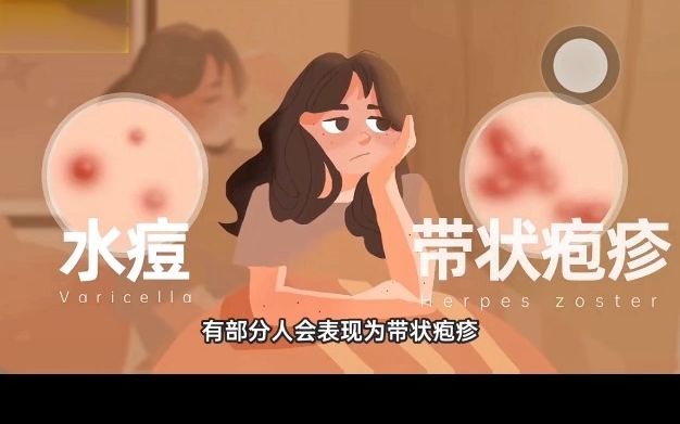 水痘带状疱疹病毒和疫苗科普哔哩哔哩bilibili