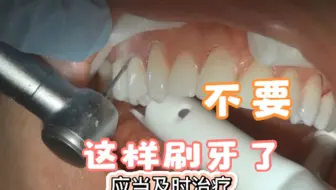 是谁把牙齿送上了断头台，不要再这样刷牙了，当心楔状缺损