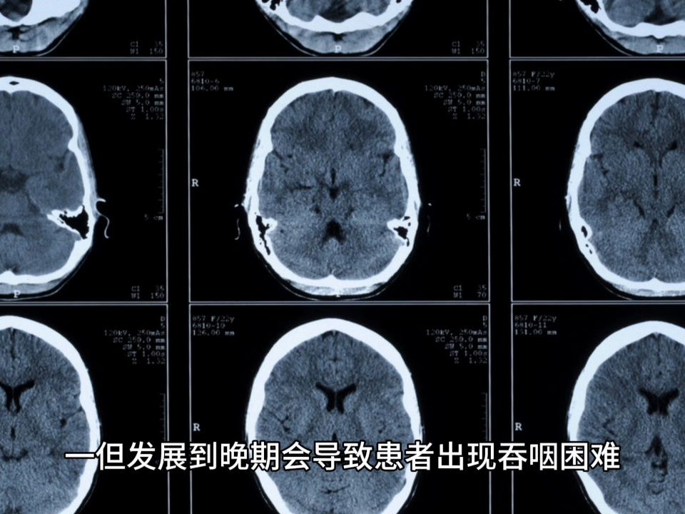 小脑萎缩与大脑萎缩的区别