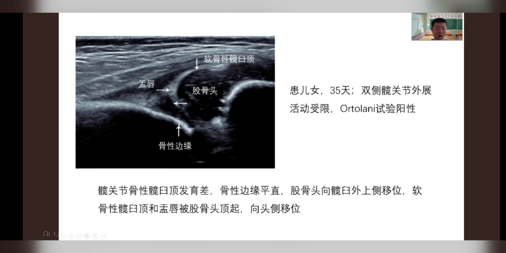 耻骨联合分离超声图片图片