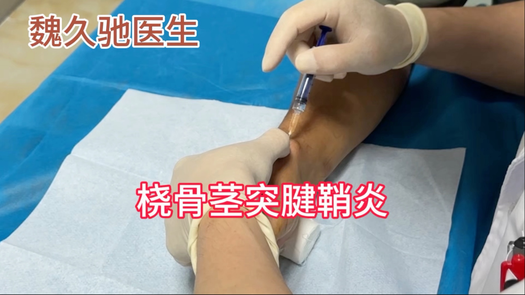 超声引导下闭合性手术治疗手腕腱鞘炎