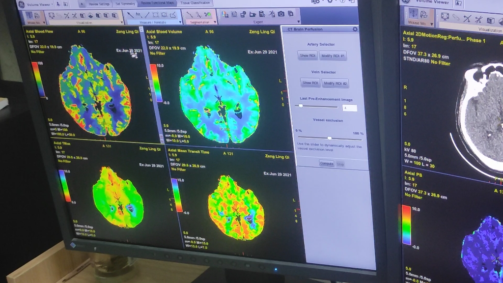 脑灌注成像图像后处理哔哩哔哩bilibili