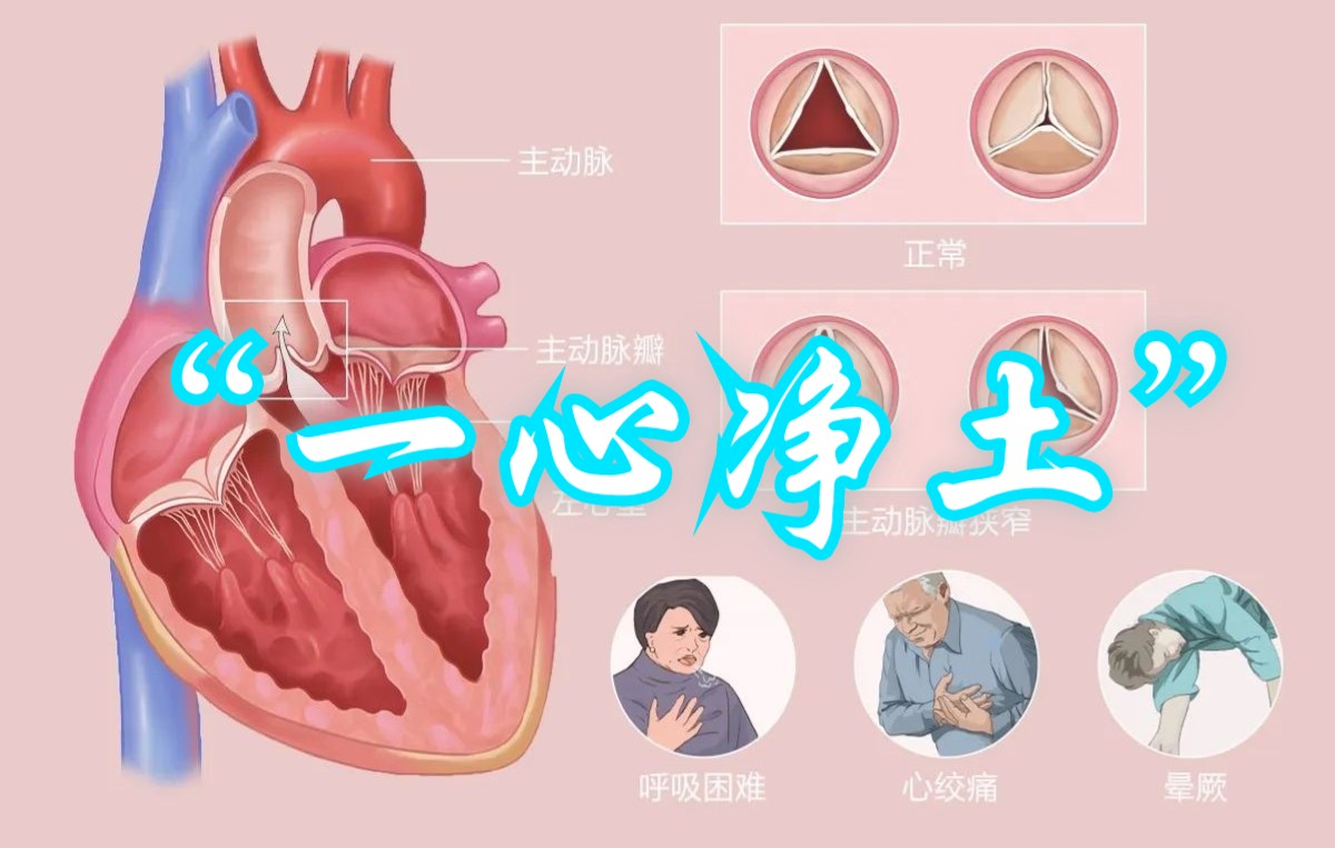 主动脉瓣上缩窄图片