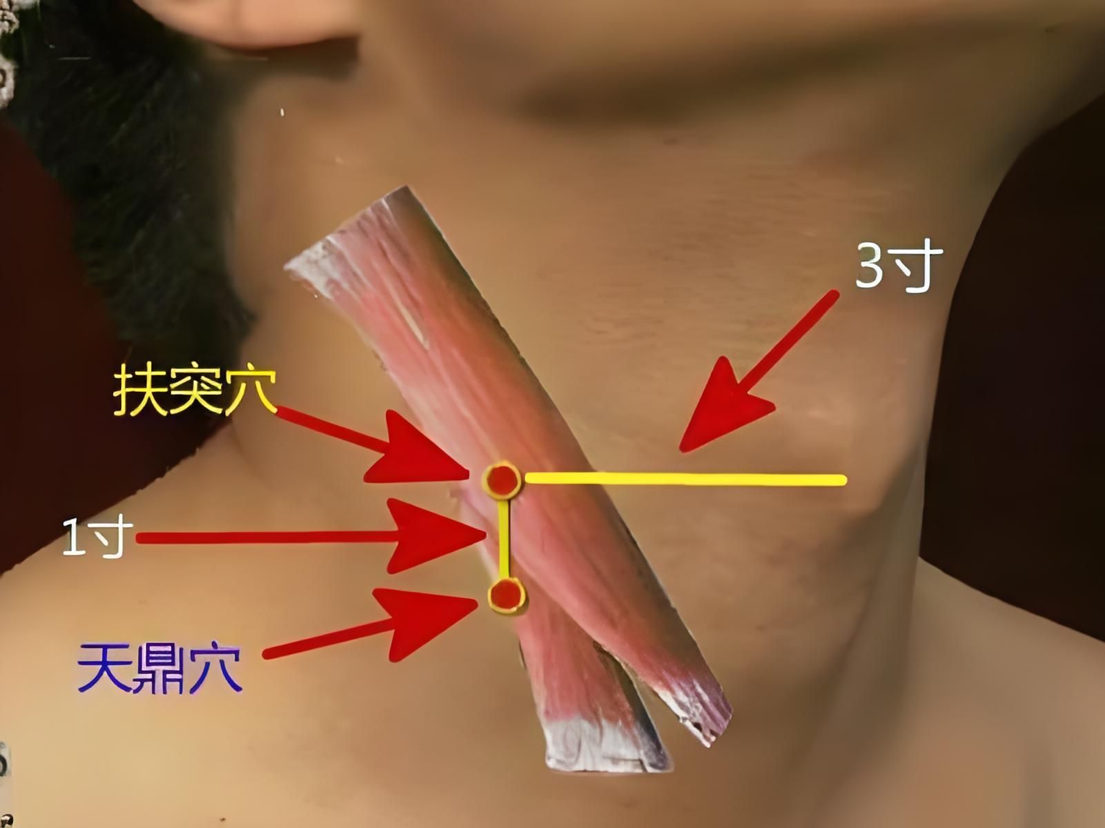 第二十三讲:手阳明大肠经 — 扶突穴 — 缓解甲状腺肿大哔哩哔哩bilibili