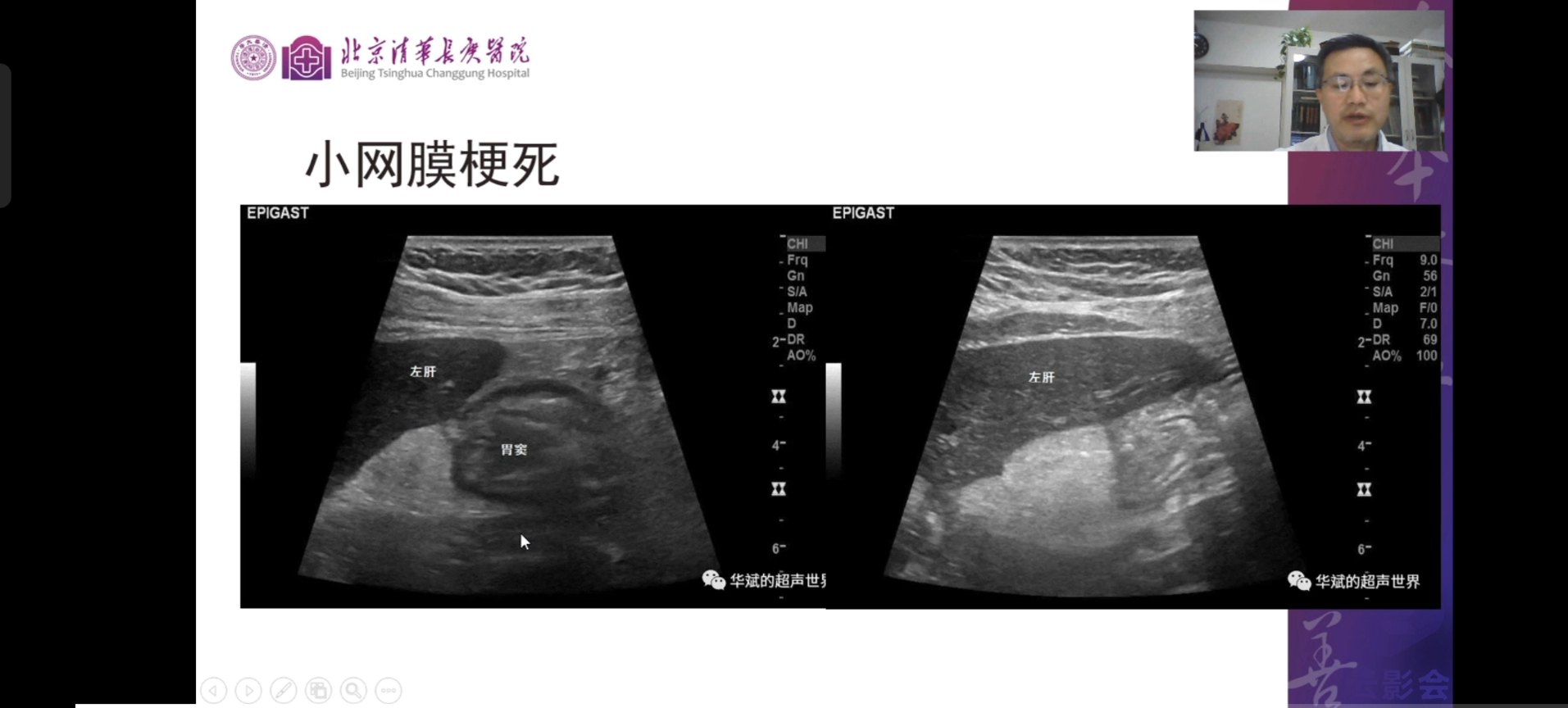 搬运.急性阑尾炎及其高仿者——超声影像学的重要性 张华斌老师哔哩哔哩bilibili