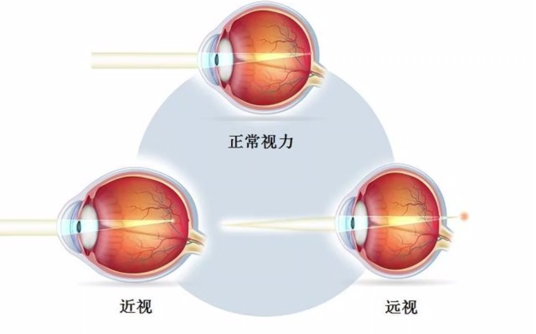 近视眼怎么慢慢恢复视力,视力下降有什么办法让视力恢复不用花钱