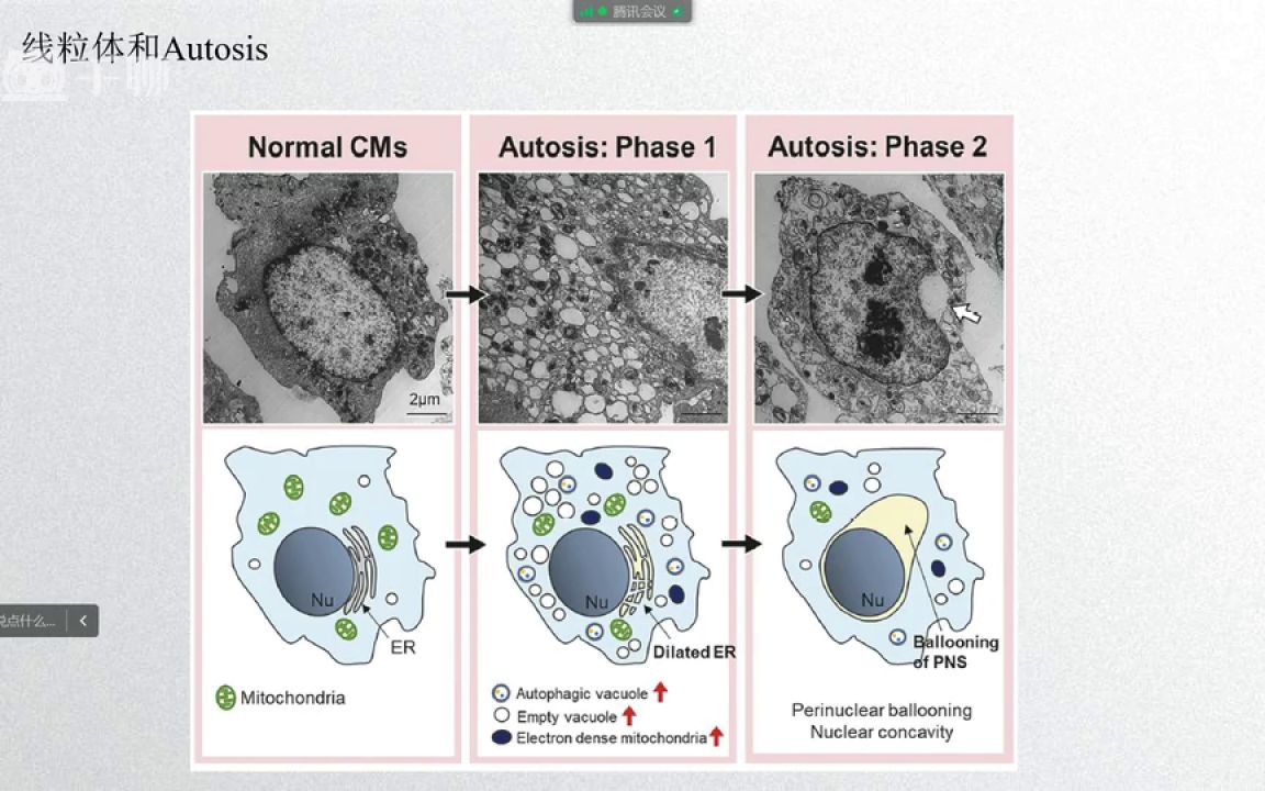 细胞焦亡多组学文章套路(表达 突变 拷贝数变异 预后)医学会员免费学