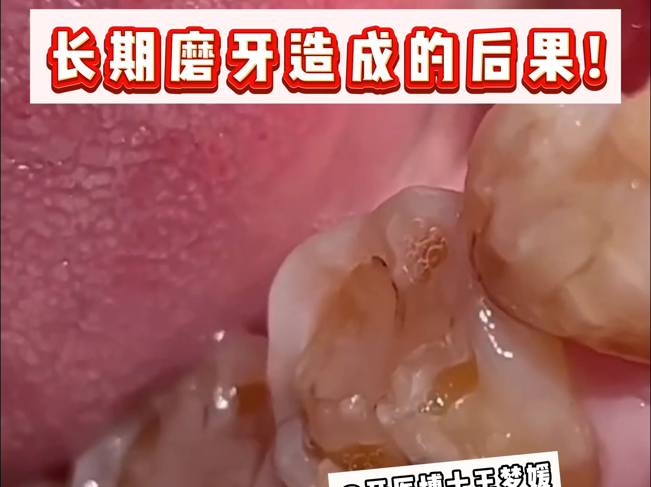 长期磨牙的后果,当心变得和视频里一样严重!