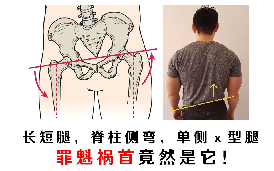 「北岛」困扰你的长短腿,脊柱侧弯,单侧x型腿的罪魁祸首竟然是高低髋!还等什么赶紧练起来吧!哔哩哔哩bilibili