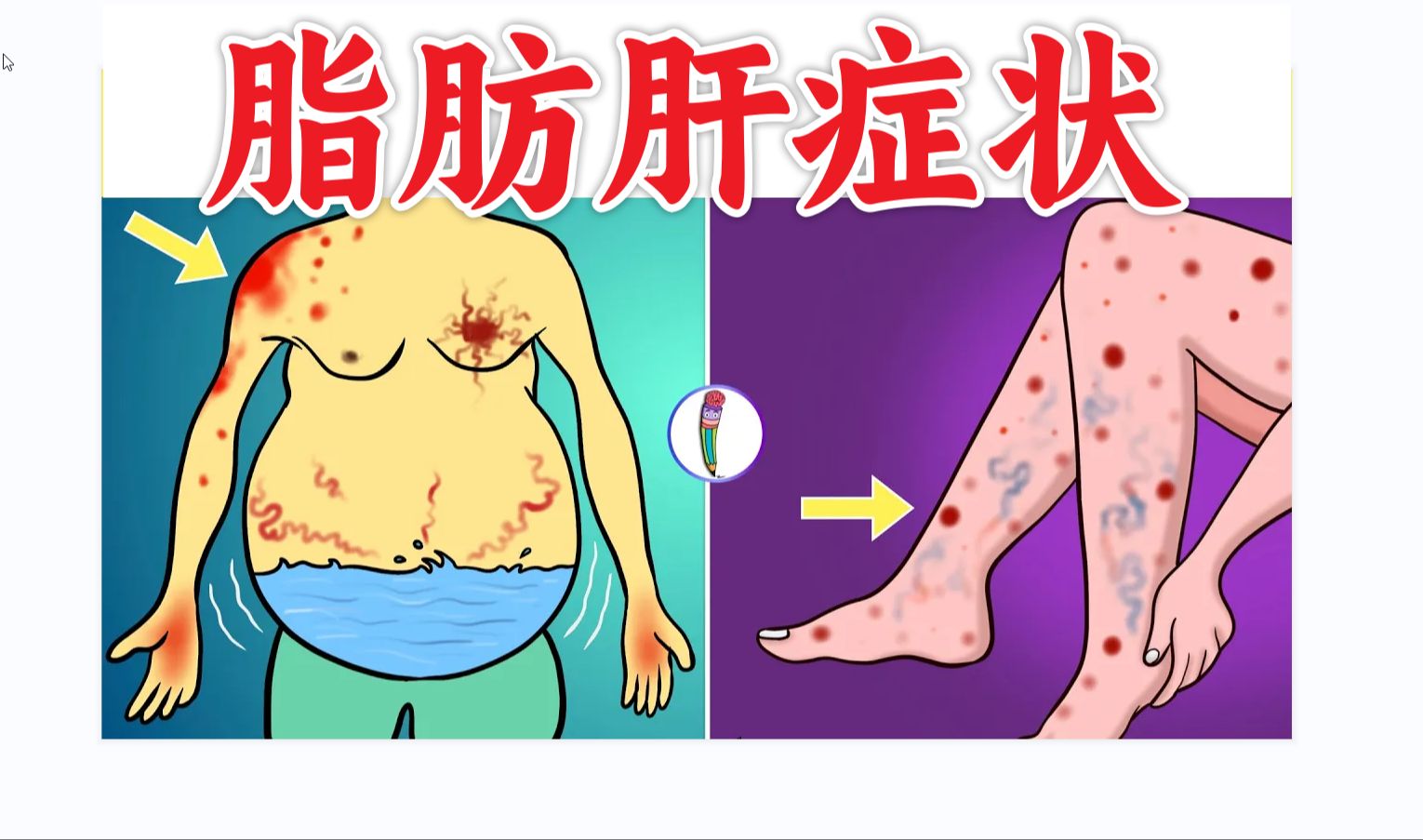 脂肪肝症状| 脂肪肝的早期症状【医学科普】