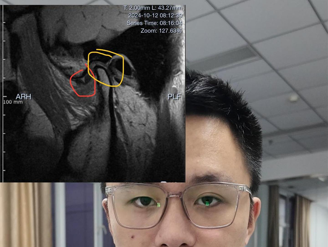 关节盘可复性前移不手法复位能不能好