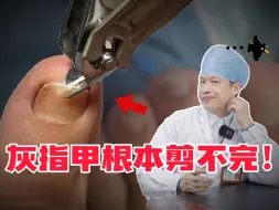 Tải video: 【科普】灰指甲你是剪不干净的，一旦发现就要及时用正规药治疗，不然会越长越多！