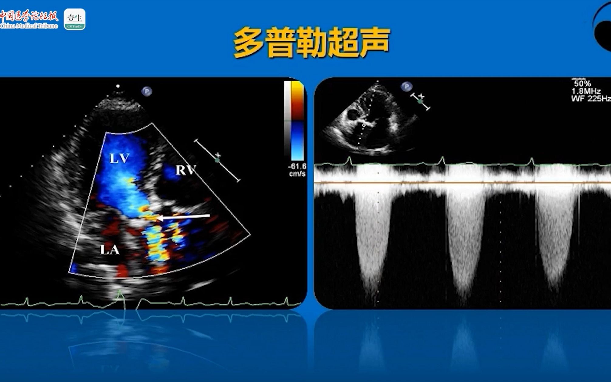 【手把手、零基础教你学心脏超声系列】23. 主动脉瓣狭窄的超声诊断哔哩哔哩bilibili