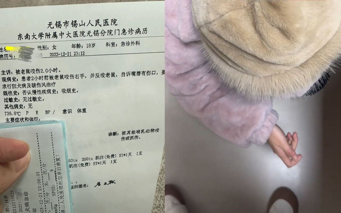 女生被老鼠咬后反咬一口,老鼠头上留牙印:感觉被挑衅,已打针