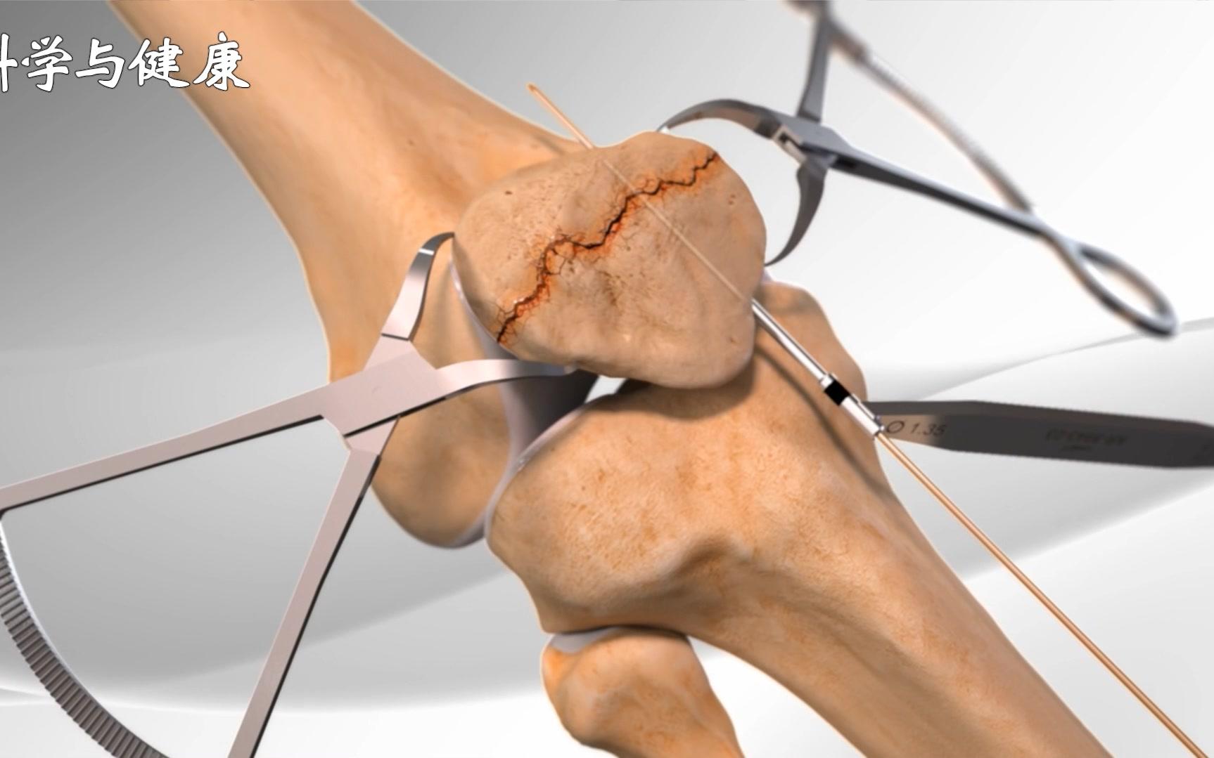 4大膝盖中箭合集3d演示髌骨骨折换半月板髌骨粉碎性骨折全膝关节置换